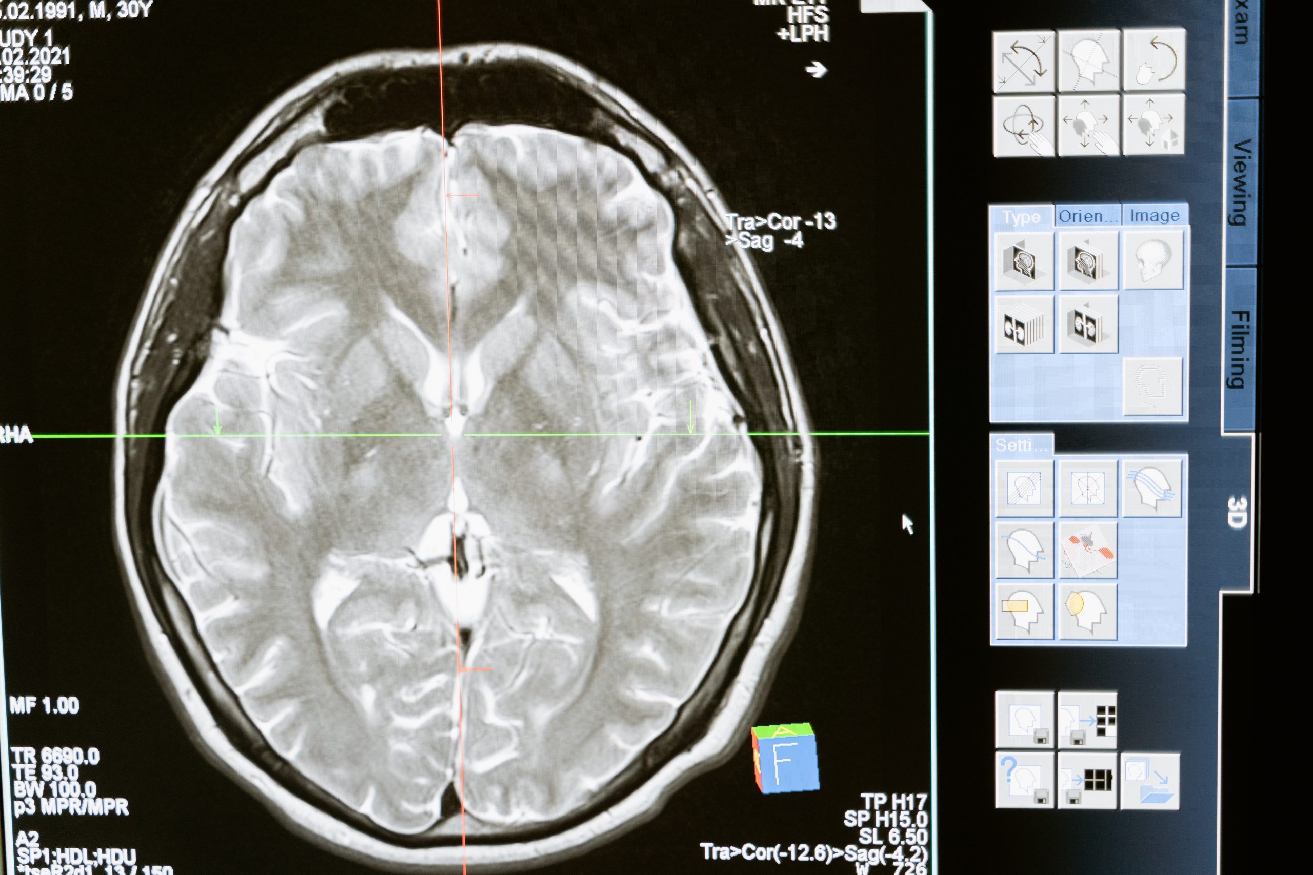 Photo d'un cliché de scanner du cerveau - EDL